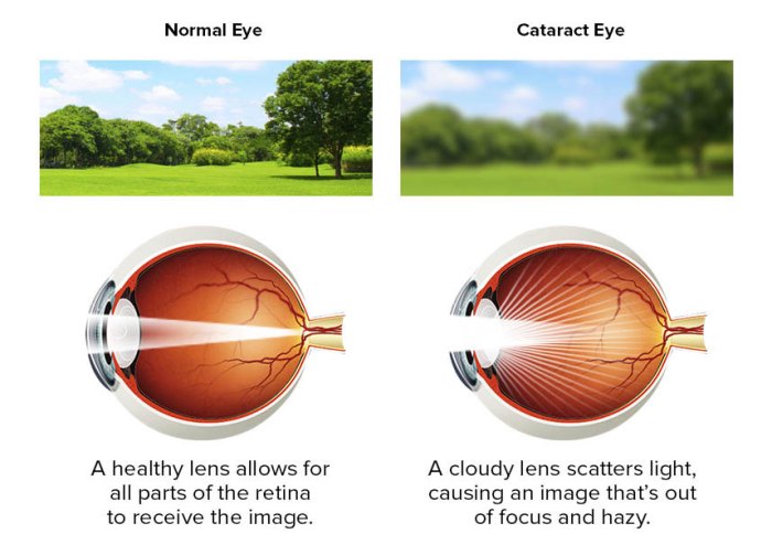 Eyesight diabetes examinations blurry thediabetescouncil